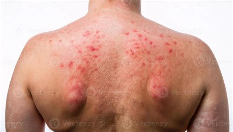 close   severe heat rash     inflamed red bumps