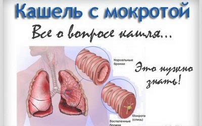 Пневмония у детей без температуры с кашлем: симптомы и признаки, лечение