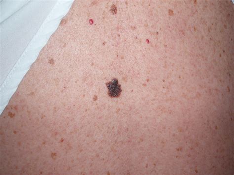 Melanoma - SEONegativo.com