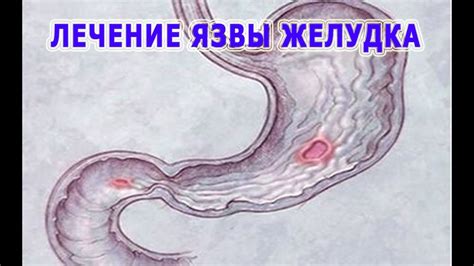★Лечение ЯЗВЫ ЖЕЛУДКА народными средствами. Несколько избранных ...