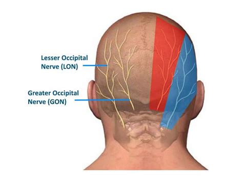 occipital neuralgia symptoms diagnosis  treatment