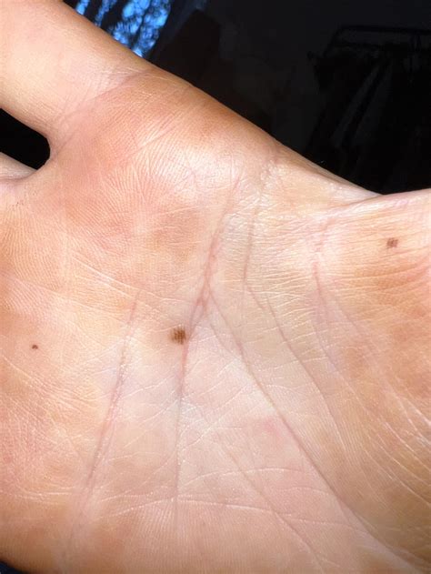 Melanoma Hand at Leo Coughlan blog