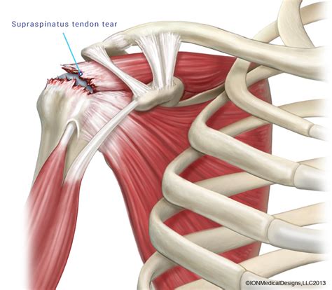 Rotator Cuff Tear Pictures Anatomy