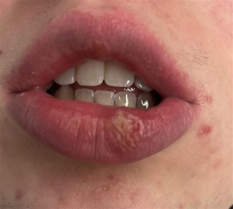 Is this a cold sore? Or just a lip complications from surgery 2 weeks ...