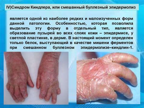 Буллезный эпидермолиз - презентация онлайн