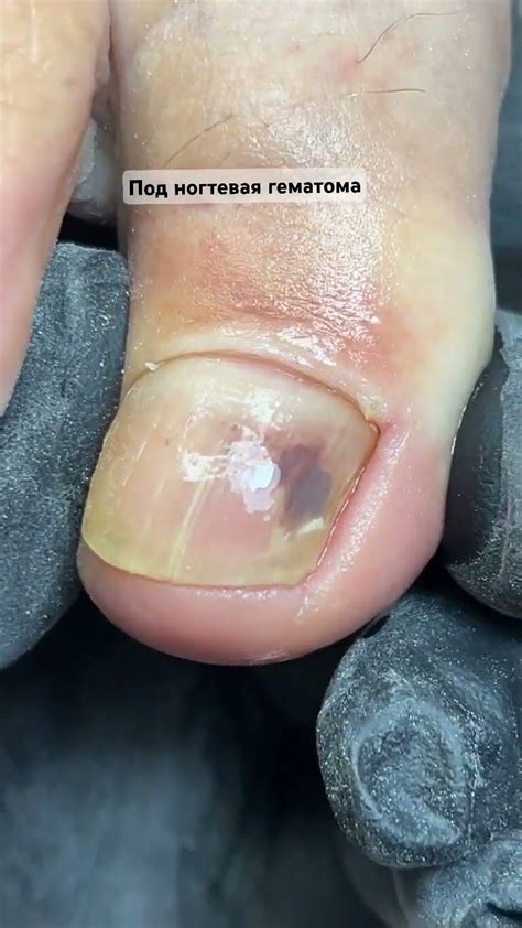 Онихолизис , поднготевая гематома #nails #ногти #pedicure #онихолизис # ...