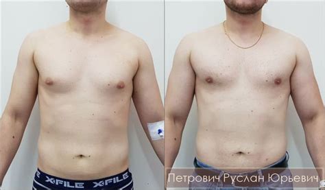 Гинекомастия симптомы лечение диагностика - фото презентация