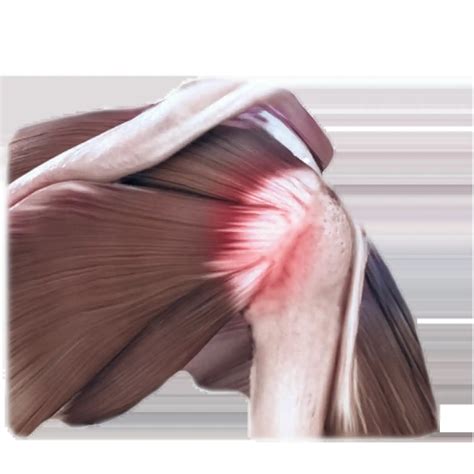 Rotator Cuff - Dr Bothma