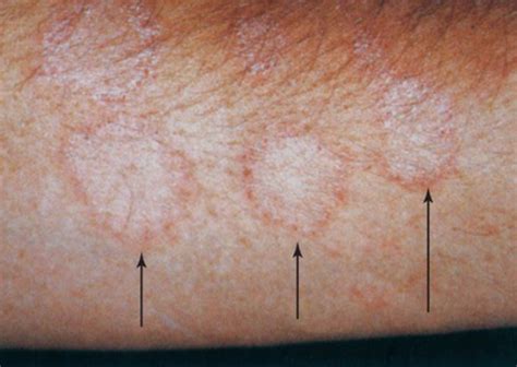 Cutaneous fungal infection Flashcards | Quizlet