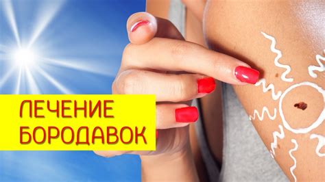 Лечение бородавок. Аптечные препараты для лечения бородавок, грибка ...