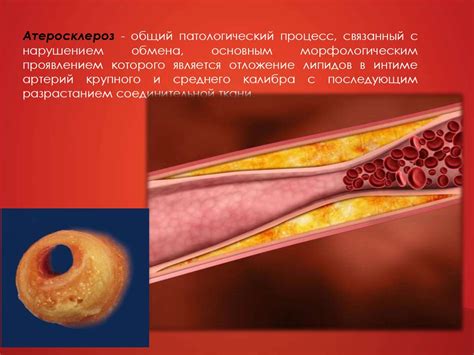 Атеросклероз. Классификация - презентация онлайн