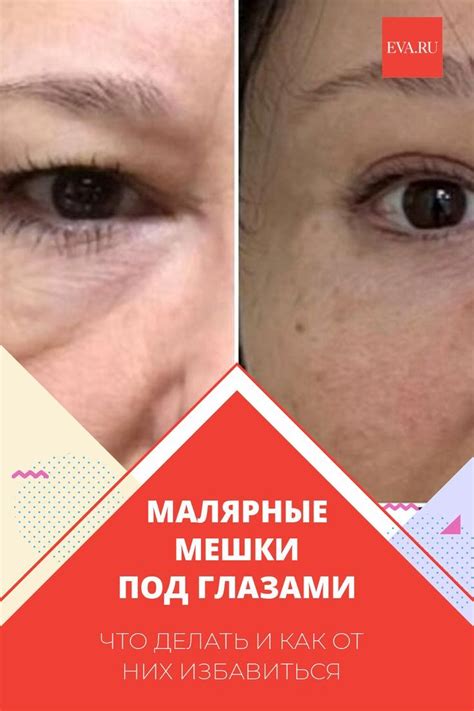 Малярные мешки под глазами: что делать и как от них избавиться | Мешки ...