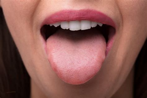 Squamous Papilloma Tongue
