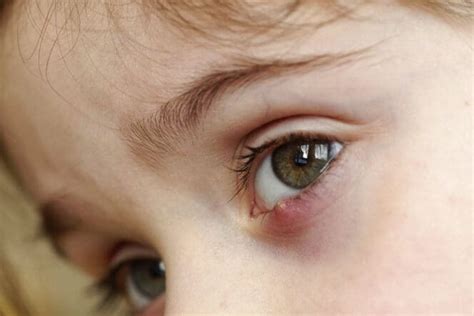 eye stye sty     treatment myvisionorg