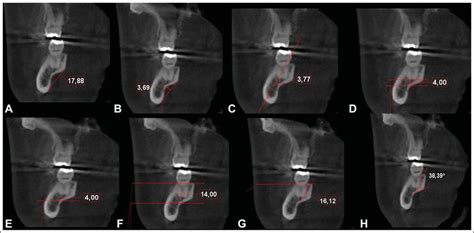 A-H, The figure showing the submandibular fossa concavity in an adult... | Download Scientific ...