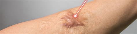 how to treat a keloid scar at home