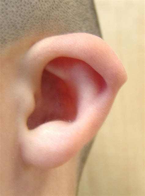 Picture of Bat Ear / Lop Ear * OTOLARYNGOLOGY HOUSTON | Surgery