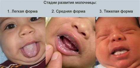 Молочница у детей во рту: проявление симптомов и лечение причин болезни