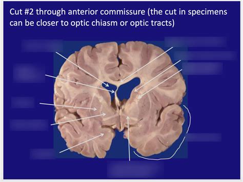 coronal section cut  diagram quizlet