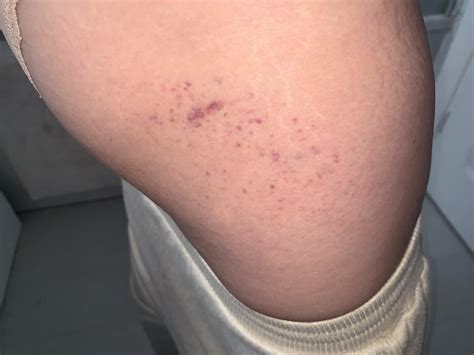20F these marks have just appeared on the side of my thigh, does anyone