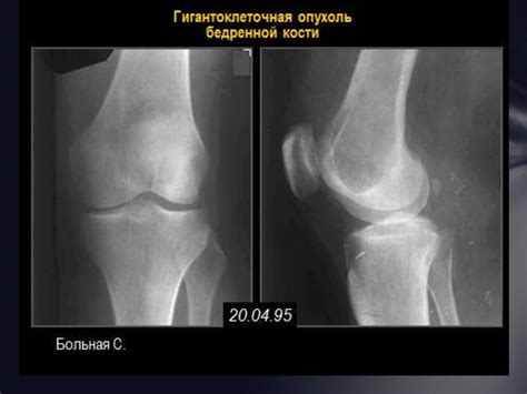 Доброкачественные опухоли костей - презентация онлайн