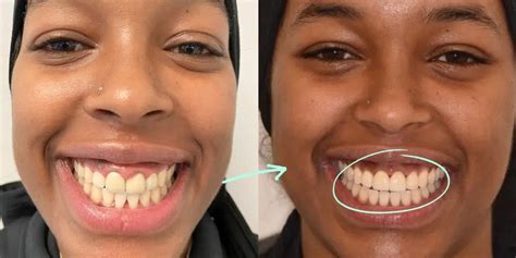 gummy smile treatment gum lift contouring melbourne