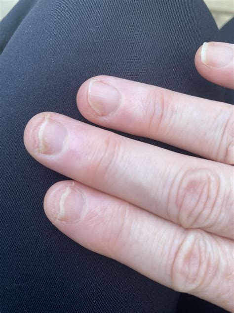 Nails lifting on multiple fingers for no reason - is this psoriasis