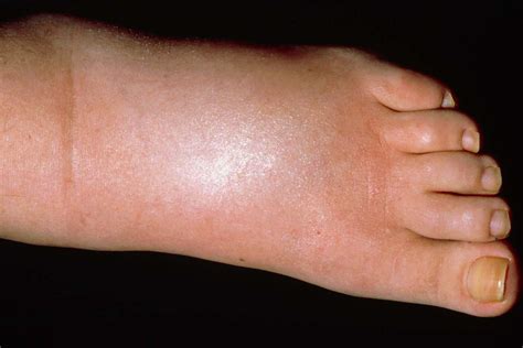 Water In Ankles And Feet