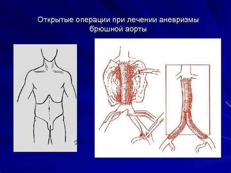 Аневризма брюшного отдела аорты Аневризмой