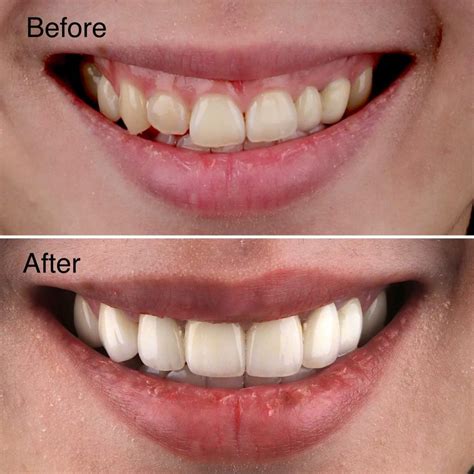 veneer veneer sbecq