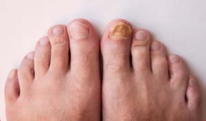 Fungus Foot: Symptoms, Prevention And Those At Risk - Greener Health