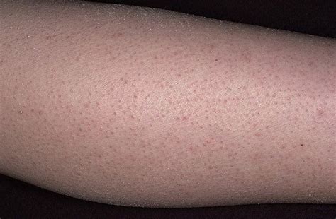 Queratosis pilar foto – 110 imágenes / fotodiagnostico.com