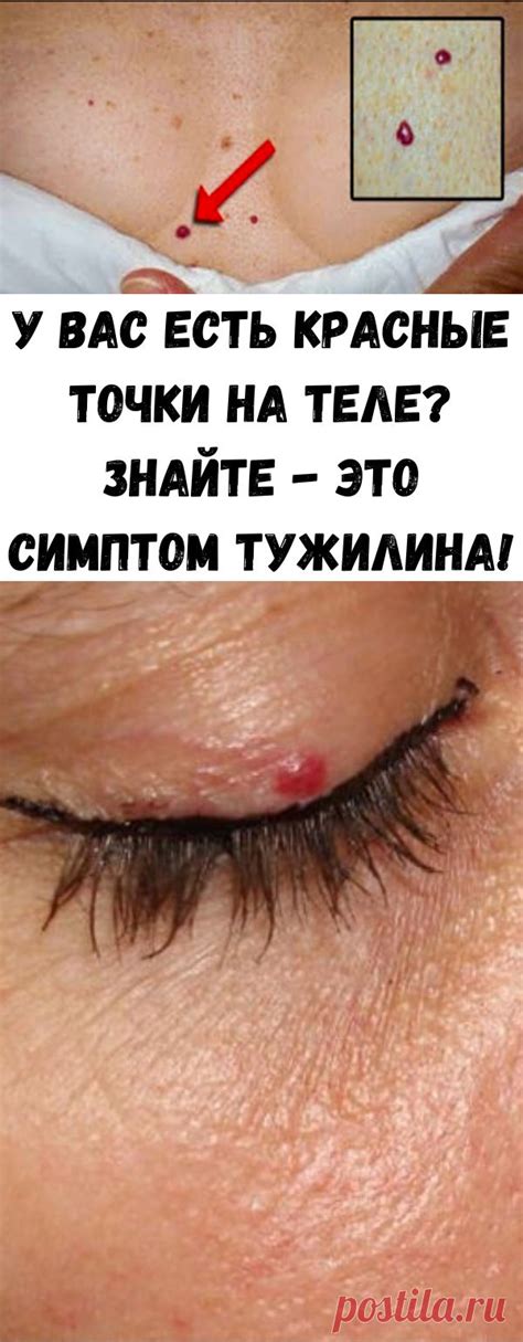 У вас есть красные точки на теле? Знайте - это симптом Тужилина ...