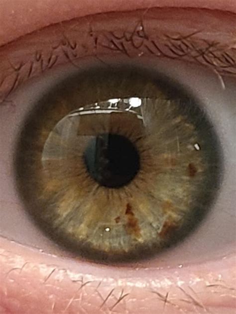 Is this partial heterochromia? : heterochromia