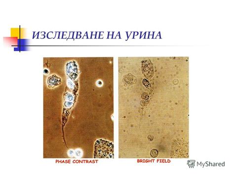 Презентация на тему: "ИЗСЛЕДВАНЕ НА УРИНА, УРИНЕН СЕДИМЕНТ, ХЕМАТУРИЯ ...