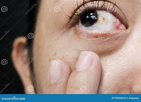 A Woman with Brown Spot on Her Eye Stock Photo - Image of hemorrhagic ...