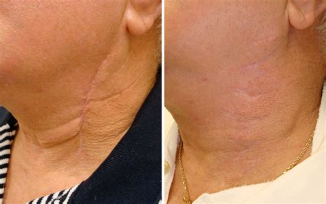 Scar Removal Annapolis MD | Scar Revision Severna Park