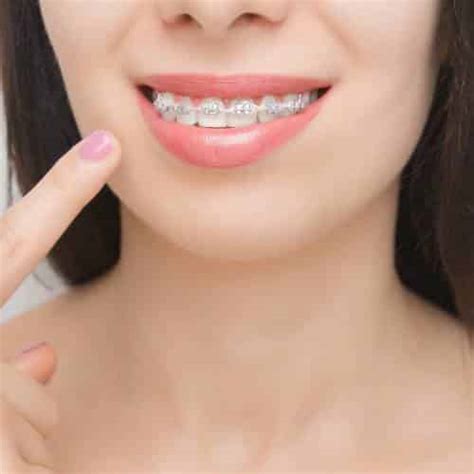 Видове брекети | Family Dental Care