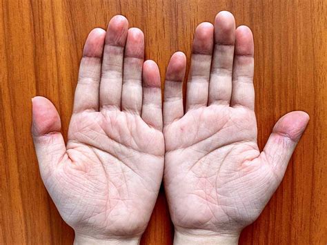 Pallor (Paleness): Types, Symptoms, Causes, & Treatment