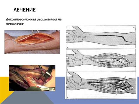 Компартмент-синдром - презентация онлайн