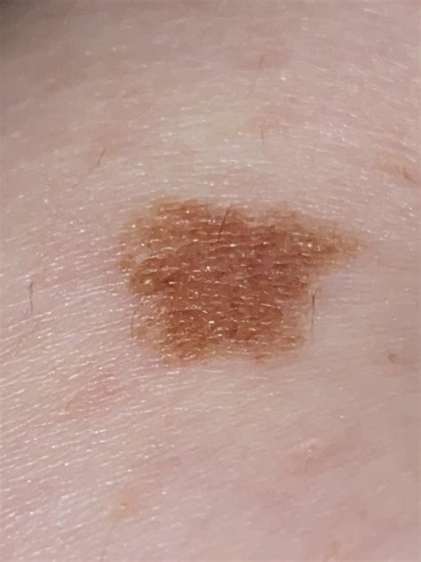 It keeps growing : r/Melanoma