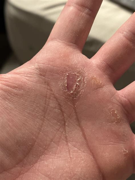 After 4 long months. The wart is gone. Merry Christmas!! : r/Warts