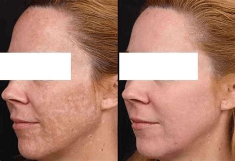 How To Fade Sun Spots And Reverse Sun Damage | Blog | HUDA BEAUTY