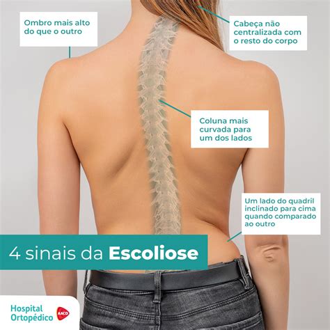 O Que Não Pode Fazer Quando Tem Escoliose - Tratamento para escoliose: entenda tudo sobre a patologia