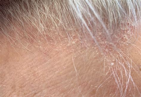 Seborrhea Scalp Seborrheic Dermatitis