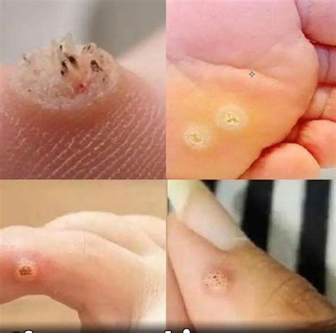 types  warts signs symptoms home remedies  treatment