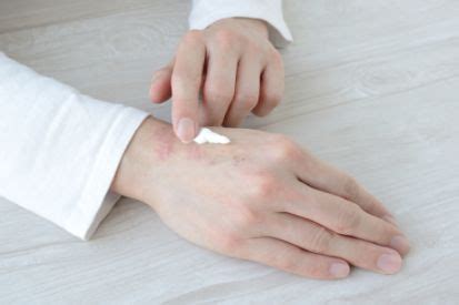 dry skin   treatment pinehurst dermatology