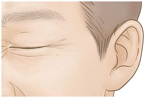 schematic image   orbicularis oculi muscle  orbicularis oculi