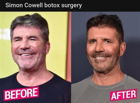 Simon Cowell botox surgery BEFORE AFTER - iFunny