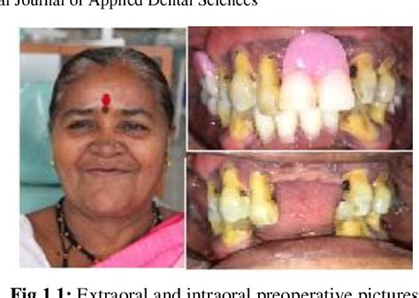 Figure 1.1 from Tooth supported overdenture: A case report | Semantic ...